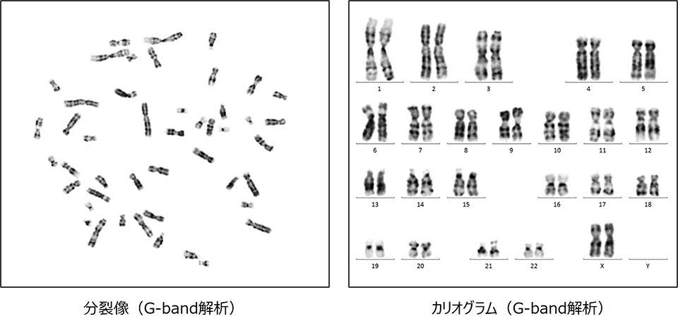 G-band解析の分裂像とカリオグラム例
