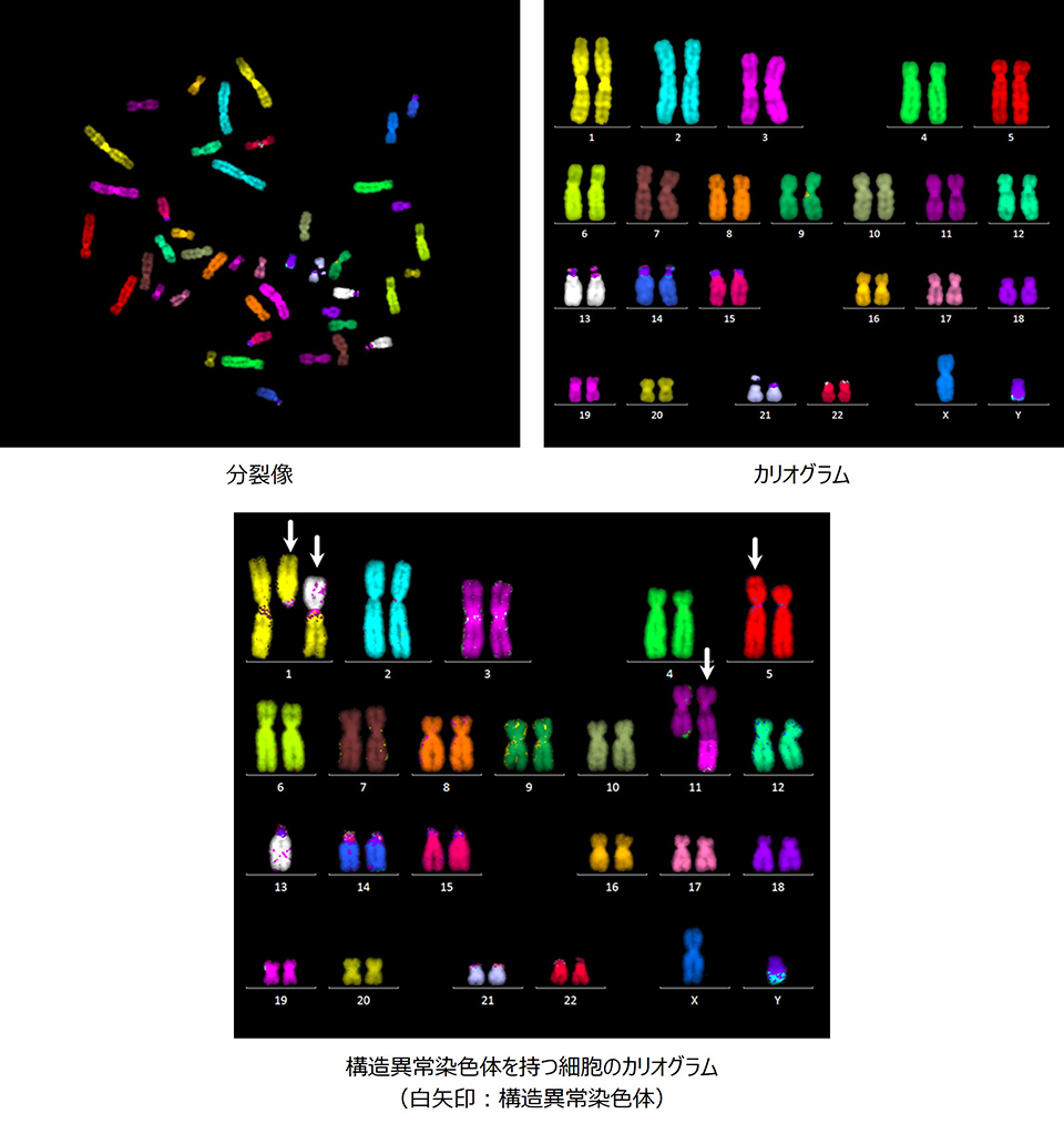 マルチカラーFISH解析の分裂像とカリオグラム例および構造異常染色体を持つ細胞のカリオグラム例